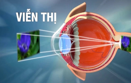Điều trị tật viễn thị
